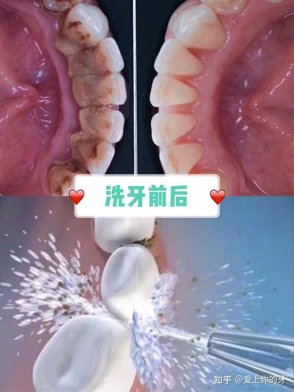 朝阳洗牙可以用医保吗(洗牙可以用医保吗,报销比例多少)